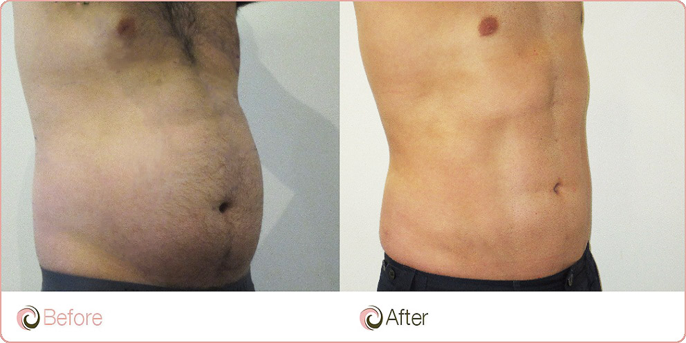 Tummy Liposuction Stomach Liposuction tummy-liposuction-stomach-liposuction