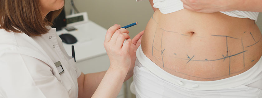 Is Vaser liposuction permanent