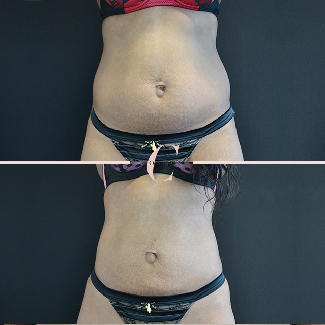 vaser liposuction before and after photos