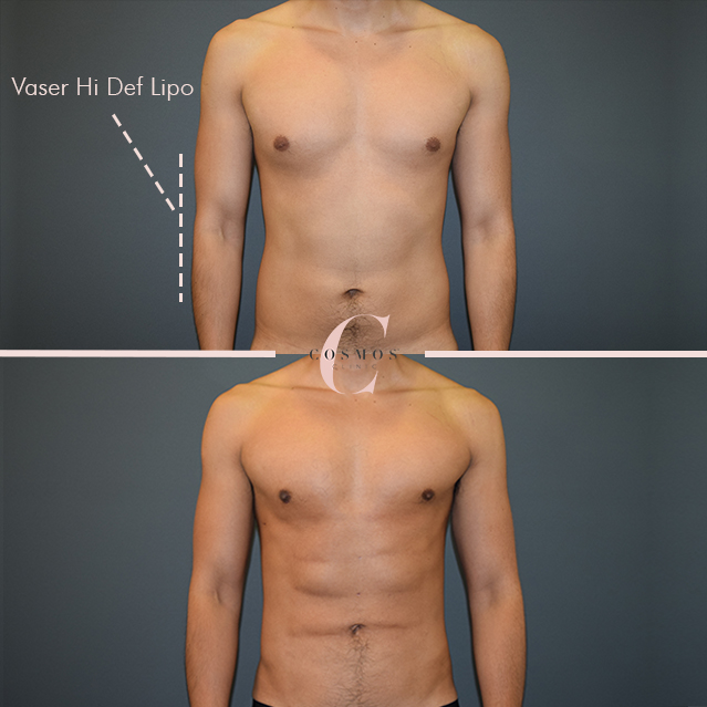 vaser hidef liposuction