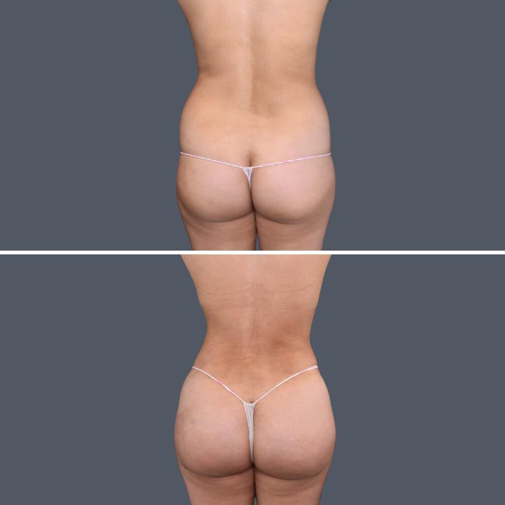 bbl liposuction